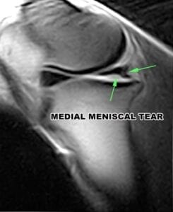 MRI Horse Meniscus Tear