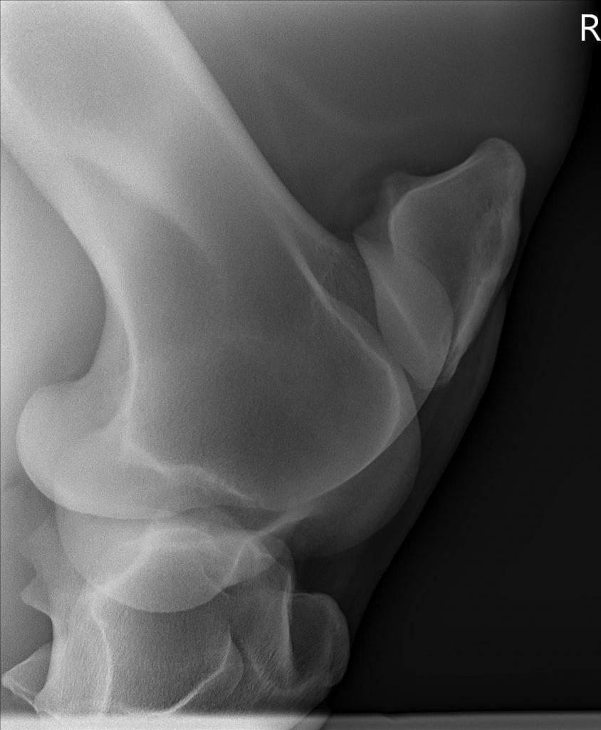 Right elbow radiograph showing fracture.