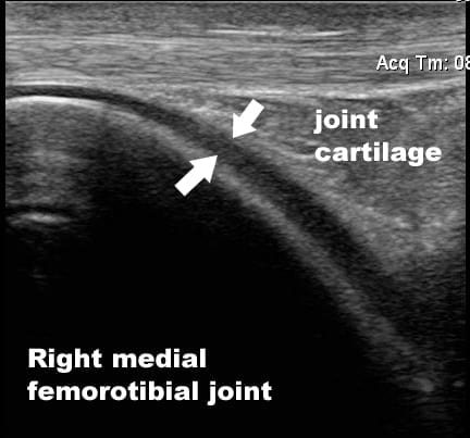 Ultrasound image: Right knee joint cartilage.