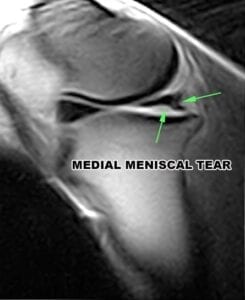 – Meniscus Tear MRI