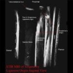 Sagittal view MRI of suspensory ligament.