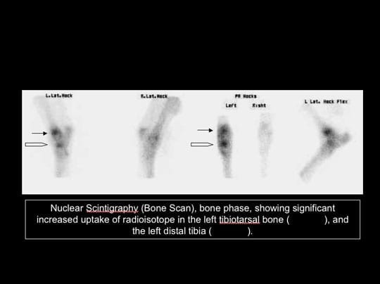 Bone scan showing increased isotope uptake in left leg.