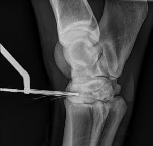 Here's an alt tag for the image: X-ray showing equine knee with pin.