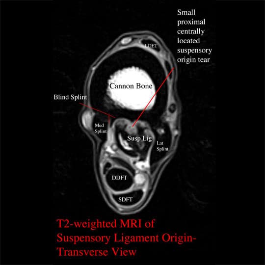 MRI of suspensory ligament origin tear.