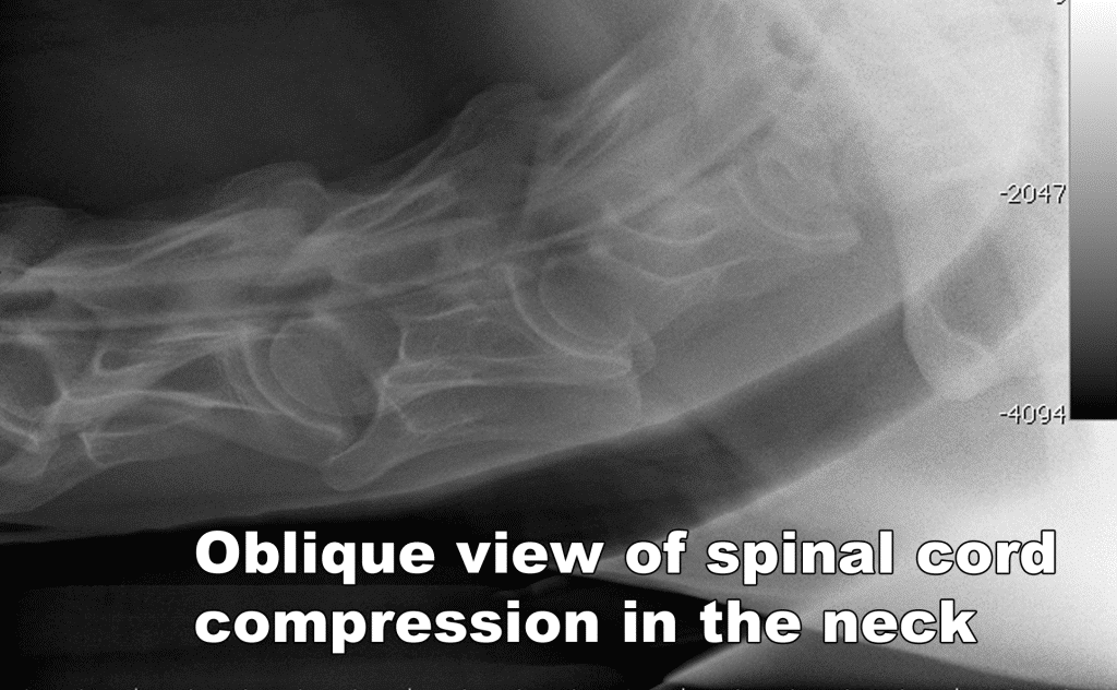 Oblique view of neck spinal cord compression.